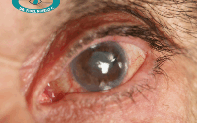 Tratamiento del glaucoma en Cuenca: diagnóstico con Dr. Nivelo