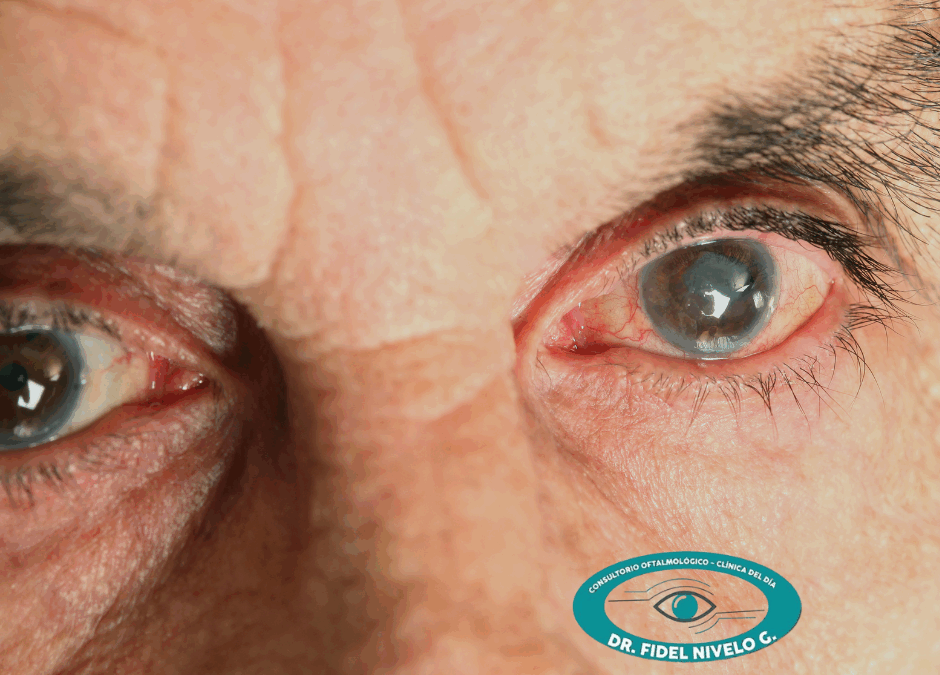 Degeneración macular en Cuenca: cómo tratarla